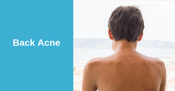 4 Active Ingredients that Treat Back Acne – Use these Products