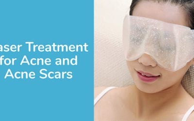 Laser Treatment for Acne and Acne Scars