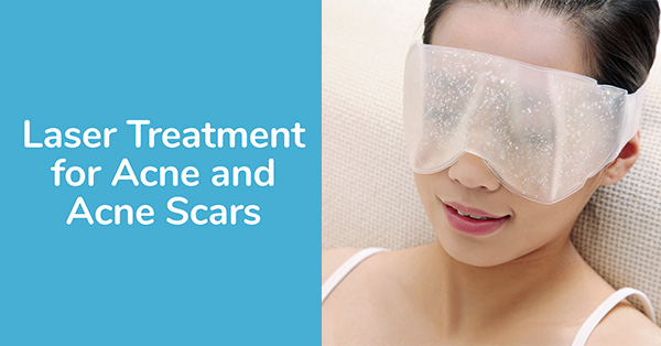 Laser Treatment for Acne and Acne Scars