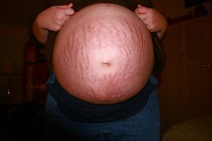 pregnant stretch marks